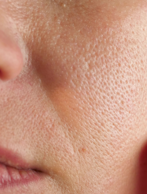 Pores dilatés